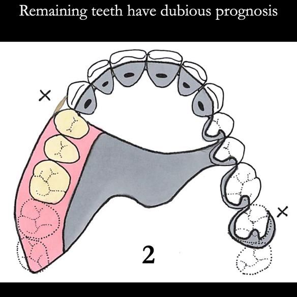 Universal Scandinavian partial denture designs