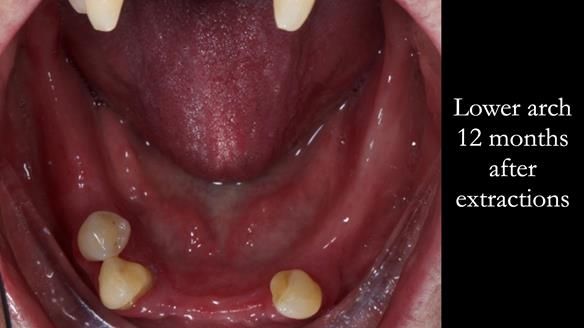 Finlay's Case Study Newsletter 40 - Immediate Mk 1 RPD to Definitive Mk 2 RPD - full protocol