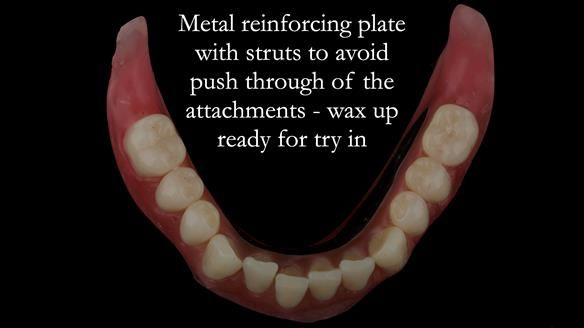 Reinforcement to implant supported dentures is crucial to reduced breakages