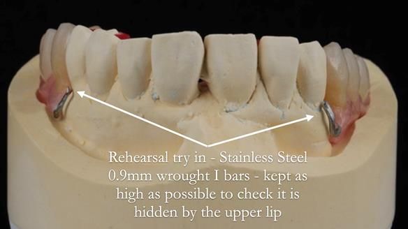 Newsletter 56 showing the making and fitting of a bilateral free end saddle upper removable partial denture (RPD) for patient with pemphigus