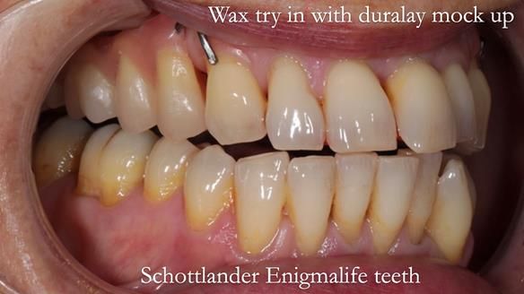 Newsletter 56 showing the making and fitting of a bilateral free end saddle upper removable partial denture (RPD) for patient with pemphigus
