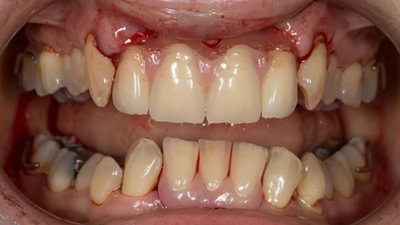 Figure 43 immediate denture fitted with teeth apart showing improved aesthetics with 3 lower incisor teeth