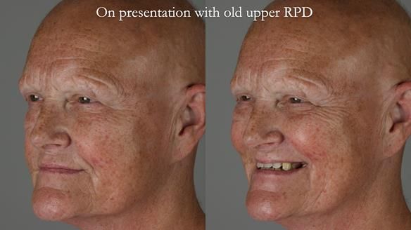 Newsletter 81 - Pam’s Story — how a partial denture changed her life (+ live walkthrough this Thursday)