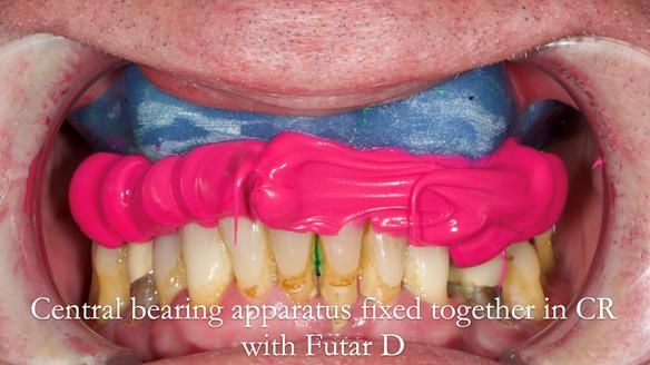 Newsletter 77: Jeremy’s case – immediate complete upper denture