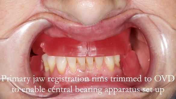 Solving Linda’s Failed “All on 4” implant bridges - full protocol Newsletter 42