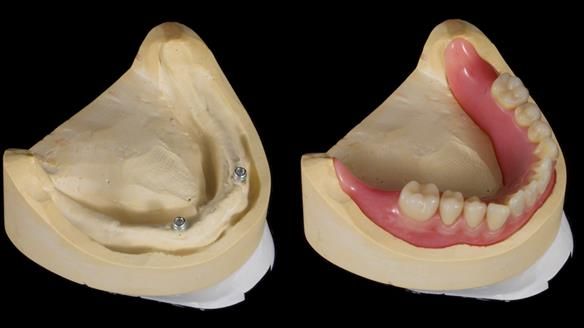 Newsletter 57 showcases the making and fitting process of implant-supported complete dentures for Alisdair