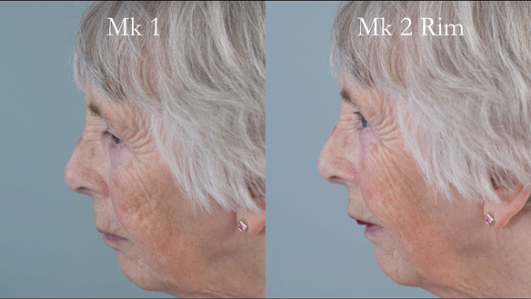 Figure 76 Comparison of Mk 1 denture and Mk 2 rim - improved lip support