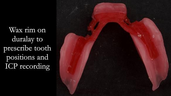 Finlay's Case Study Newsletter 40 - Immediate Mk 1 RPD to Definitive Mk 2 RPD - full protocol