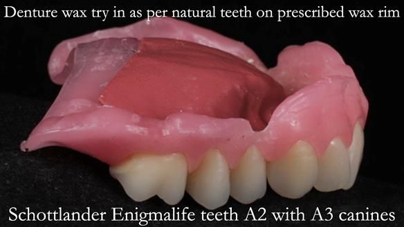 Finlay's Newsletter 58 Gasket upper partial denture for Zoe