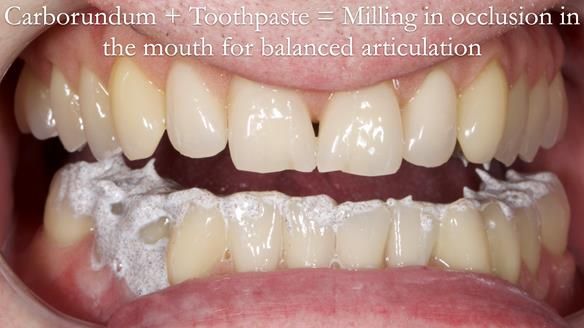 Newsletter 57 showcases the making and fitting process of implant-supported complete dentures for Alisdair
