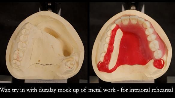 Upper metal base partial denture/occlusal stabilisation splint/obturator - full protocol