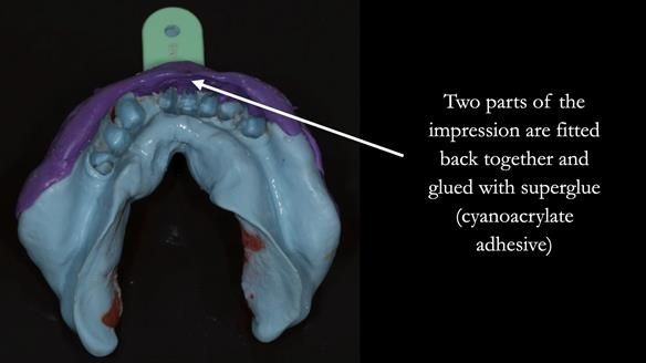 Finlay's Case Study Newsletter 40 - Immediate Mk 1 RPD to Definitive Mk 2 RPD - full protocol