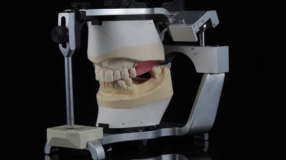 Newsletter 56 showing the making and fitting of a bilateral free end saddle upper removable partial denture (RPD) for patient with pemphigus