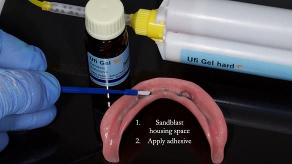 Newsletter 78: What do Clark Gable and a Locator® overdenture have in common?