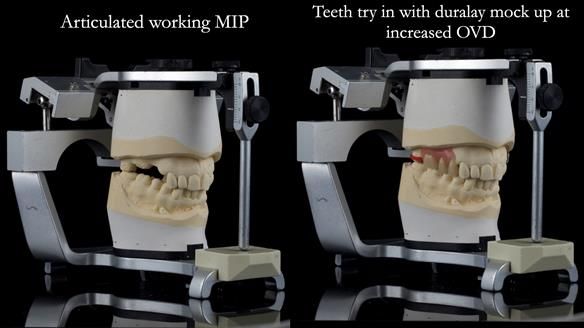 Finlay's Newsletter 60 Sylvia's upper Kennedy Class 2 Mod 1 metal based upper RPD