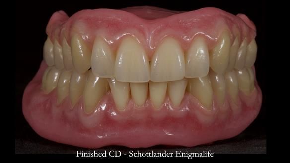 Newsletter 83: Sheila’s Complete Denture Success