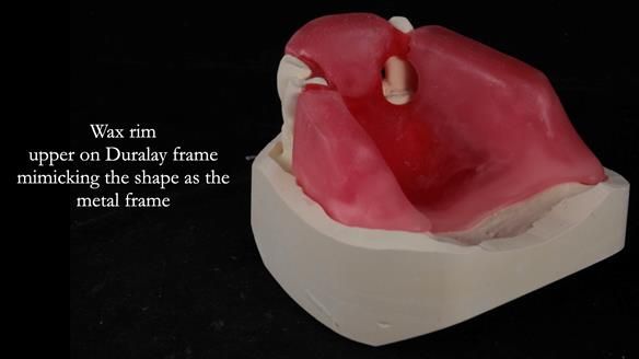 Finlay's Newsletter 59 Ultra hard partial dentures made for Gill