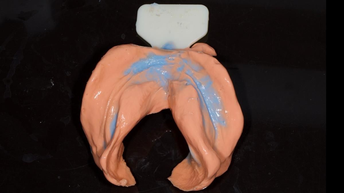Fin’s Newsletter 88 — Complete dentures - full protocol… he rearranged his own teeth!