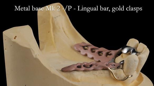 Newsletter 52 Managing Jo’s failing dentition with extractions and Mk 1/Mk 2 complete upper dentures and lower partial dentures FULL PROTOCOL