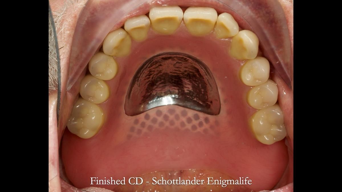 Newsletter 87 – Father Peter: A Partial Denture that needed Minor Miracle
