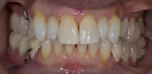 Figure 43 Temporary crowns and Mk 1 dentures fitted.