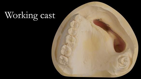 Upper metal base partial denture/occlusal stabilisation splint/obturator - full protocol