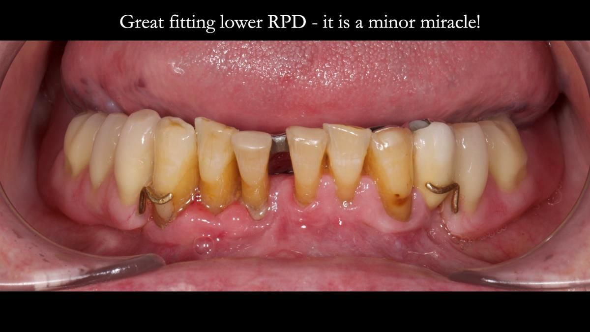 Newsletter 87 – Father Peter: A Partial Denture that needed Minor Miracle