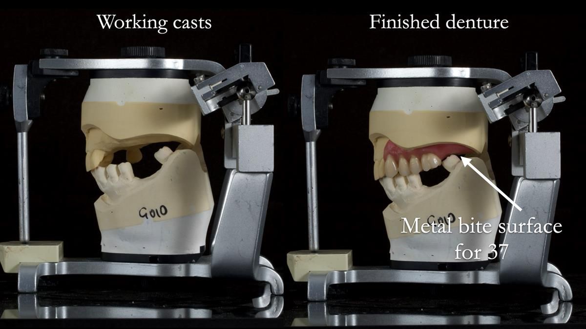 Newsletter 89 – Simon: A Challenging Kennedy Class II Division 1 Upper CoCr Partial Denture with a High Smile Line