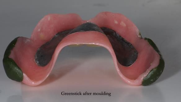 Newsletter 77: Jeremy’s case – immediate complete upper denture