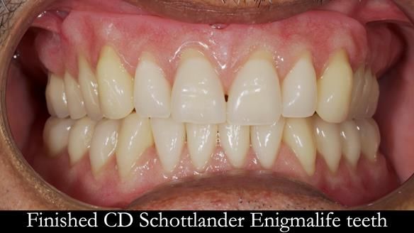 Finlay's Newsletter 62 provision of extractions and metal based complete dentures for Rafique