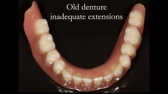 More “muscle trimming” on the left side compared to the right side. Dentist who took the working impressions may have been right handed. Poor denture shape (under extended in retro molar pads) probably from incorrectly extended custom tray and inadequate