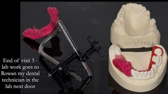 Finlay's Newsletter 61 provision of a lower unilateral free end saddle metal based partial denture for Joyce