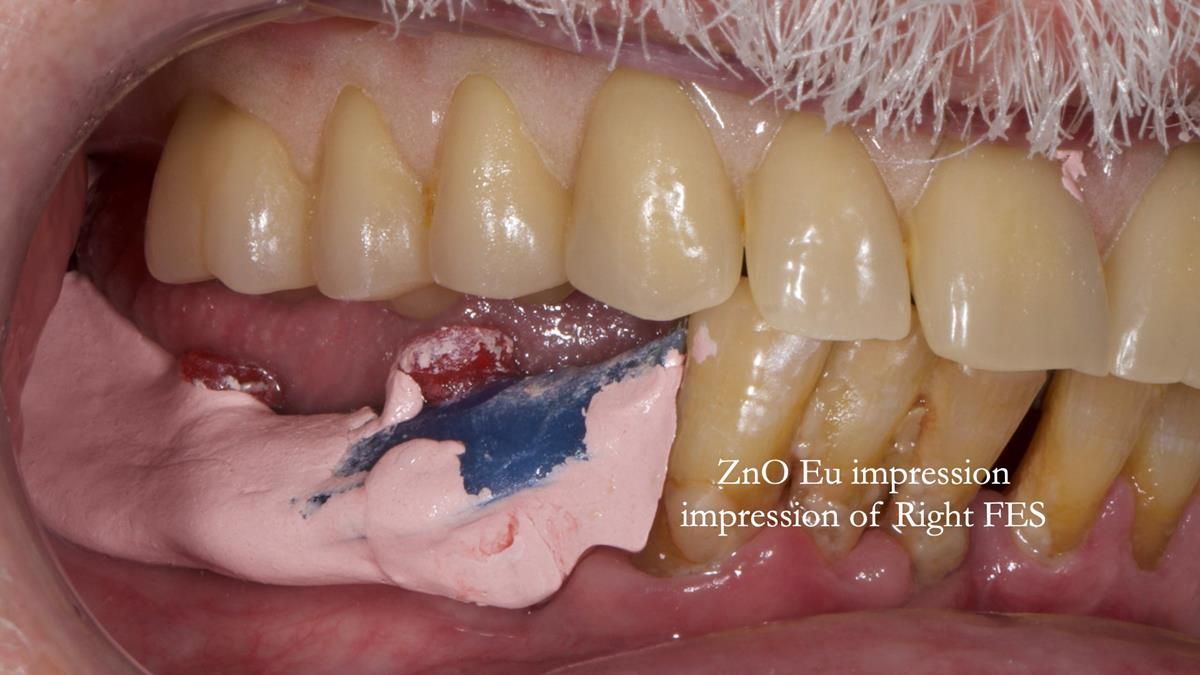 Newsletter 87 – Father Peter: A Partial Denture that needed Minor Miracle