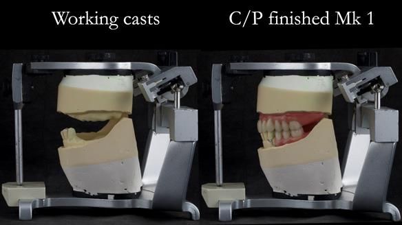 Newsletter 52 Managing Jo’s failing dentition with extractions and Mk 1/Mk 2 complete upper dentures and lower partial dentures FULL PROTOCOL