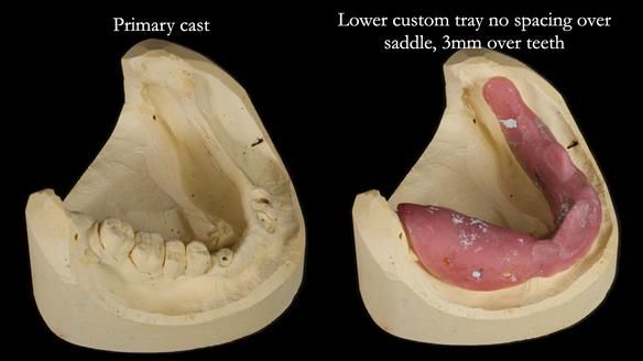 Newsletter 82 Mary - A complete upper and a one-tooth gasket denture