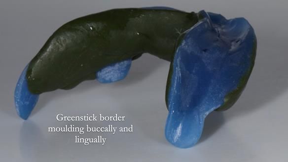 Newsletter 83: Sheila’s Complete Denture Success