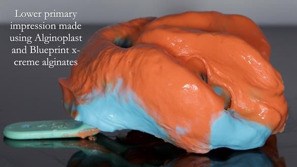 Newsletter 82 Mary - A complete upper and a one-tooth gasket denture