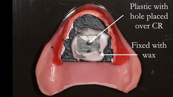 Newsletter 54 case presentation upper complete denture and lower Scandinavian designed hygienic partial denture for David