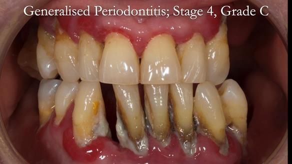 Finlay's Case Study Newsletter 40 - Immediate Mk 1 RPD to Definitive Mk 2 RPD - full protocol