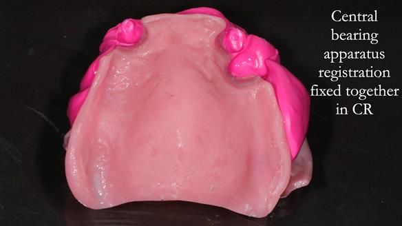 Finlay's Newsletter 59 Ultra hard partial dentures made for Gill
