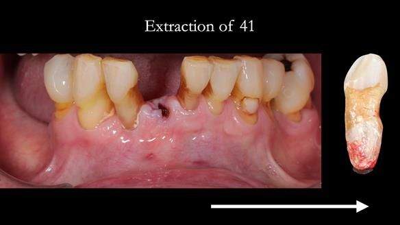 Newsletter 54 case presentation upper complete denture and lower Scandinavian designed hygienic partial denture for David