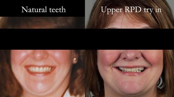 Finlay's Newsletter 58 Gasket upper partial denture for Zoe