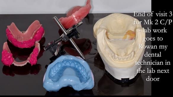 Newsletter 52 Managing Jo’s failing dentition with extractions and Mk 1/Mk 2 complete upper dentures and lower partial dentures FULL PROTOCOL