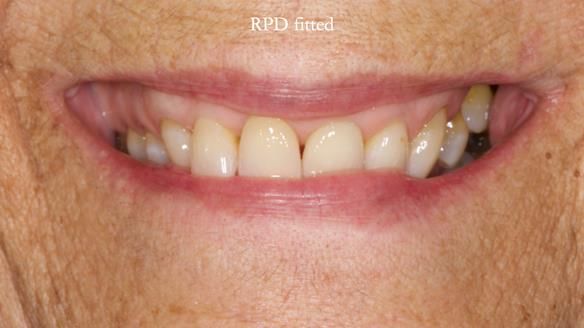 Finlay's Newsletter 61 provision of a lower unilateral free end saddle metal based partial denture for Joyce