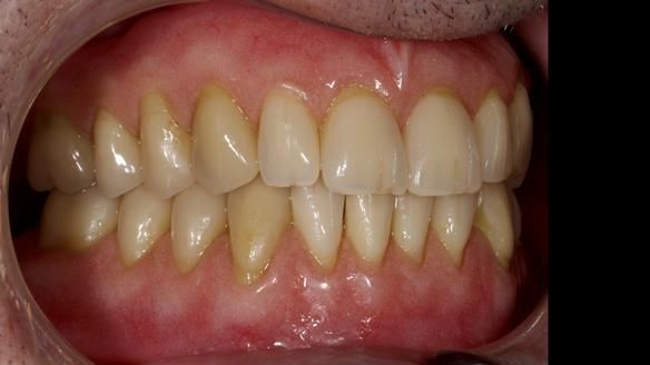 Newsletter 80 - Gordon’s dentures: the one case in 1,000 where my technique failed