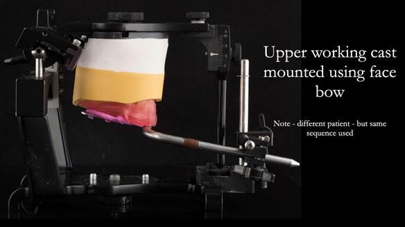 The upper working cast is fitted to the top member of the articulator using plaster