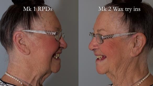 Finlay's Case Study Newsletter 40 - Immediate Mk 1 RPD to Definitive Mk 2 RPD - full protocol