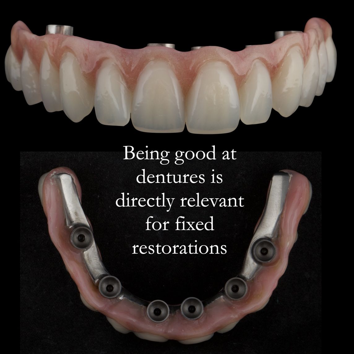 Being good at removable prosthodontics is directly relevant to fixed implant prosthodontics