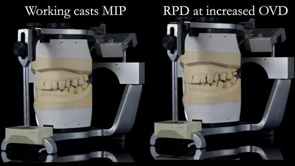Finlay's Newsletter 64 case study - provision of a Kennedy class 2 metal based Scandinavian RPD for Ian