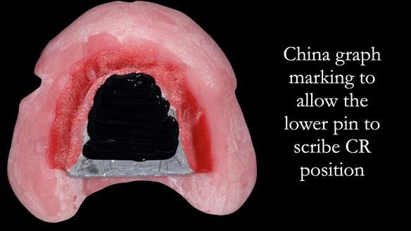 Complete denture Class II div 2 deep overbite Newsletter 39